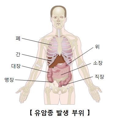 위유암종