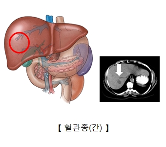 혈관종