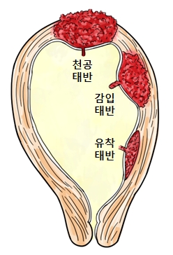 태반유착증