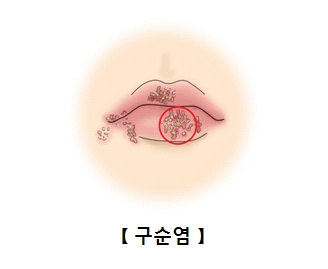 구순염