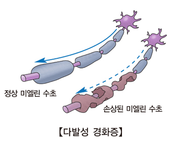 스핑고 지질증