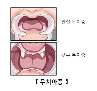 무치아증