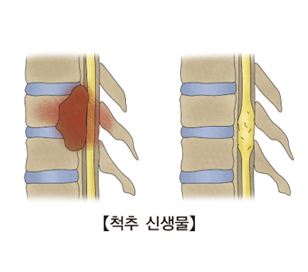 척추 신생물