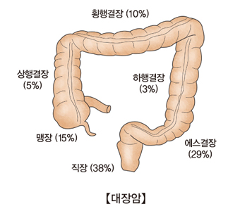 대장암