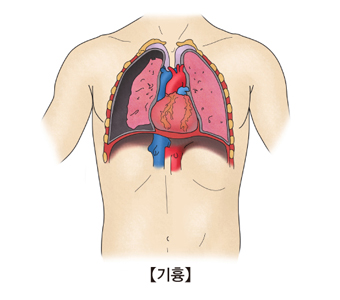 공기가슴증