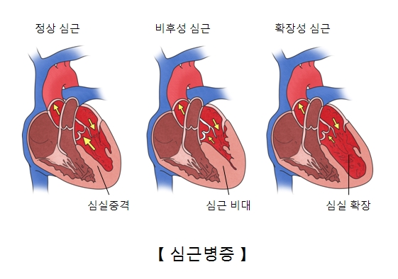 심근병증