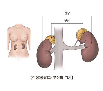 신장의 신생물