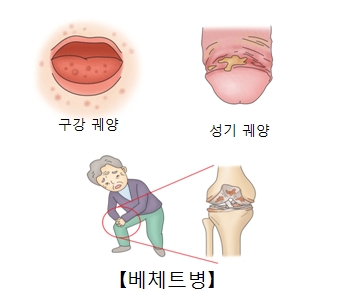 베체트 병