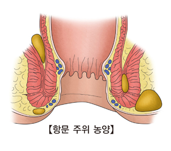 항문주위 농양