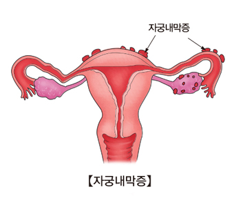 자궁내막증