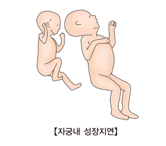 자궁 내 성장지연