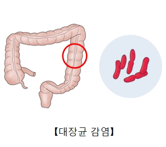 대장균 감염