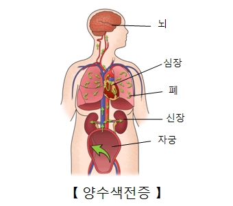 양수색전증