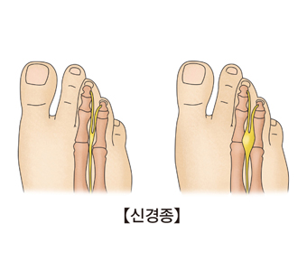 신경종