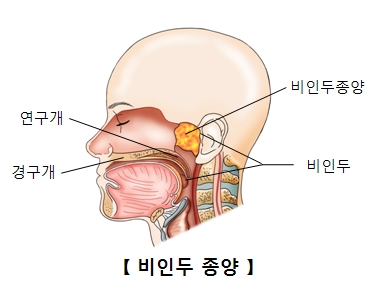 비인두종양