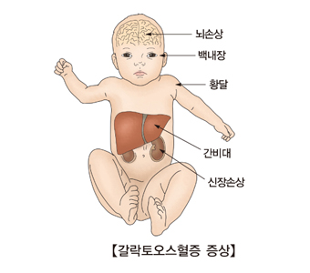 갈락토오스혈증