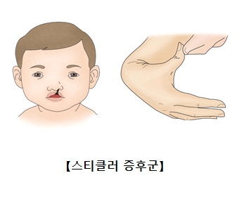 스티클러 증후군