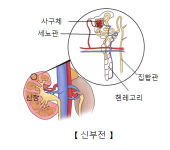 급성 신부전