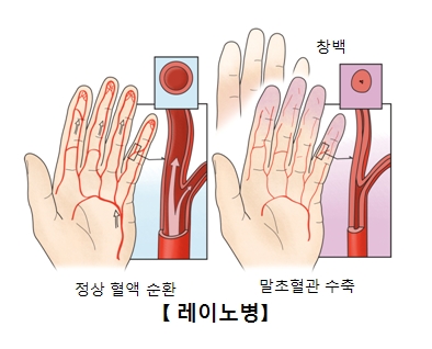 레이노병