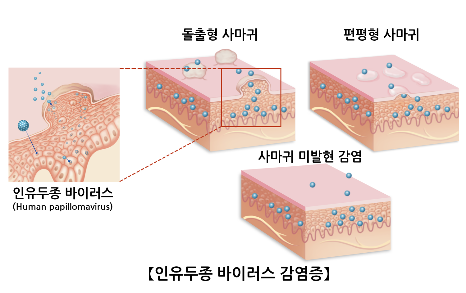 인유두종 바이러스 감염증