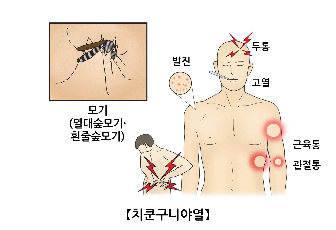 치쿤구니야