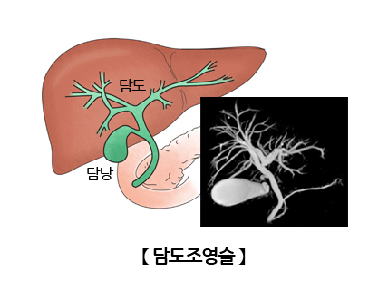 담도조영술