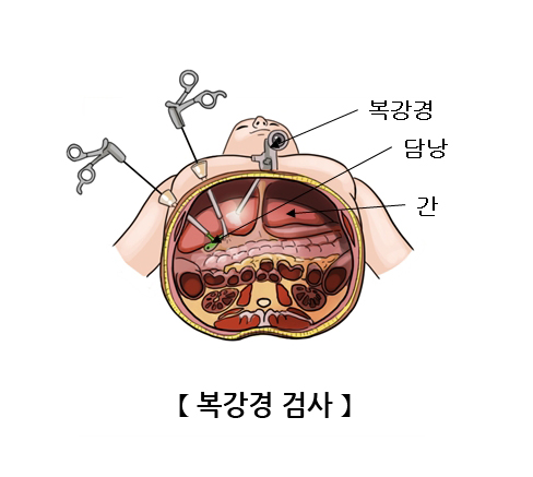 복강경