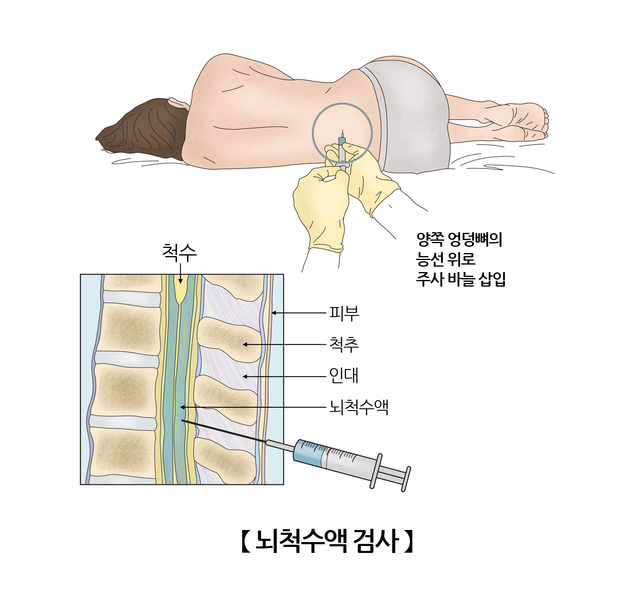 뇌척수액검사