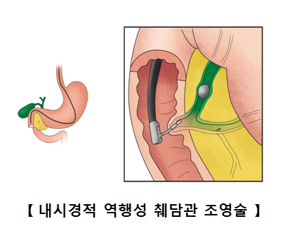 내시경 역행성 췌담관 조영술